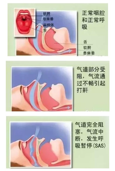 呼吸機可以完全治愈睡眠呼吸暫停嗎？